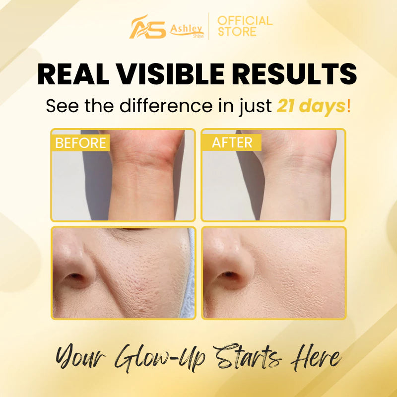 Ashley Shine Niacinamide Ultimate Glow Serum before and after