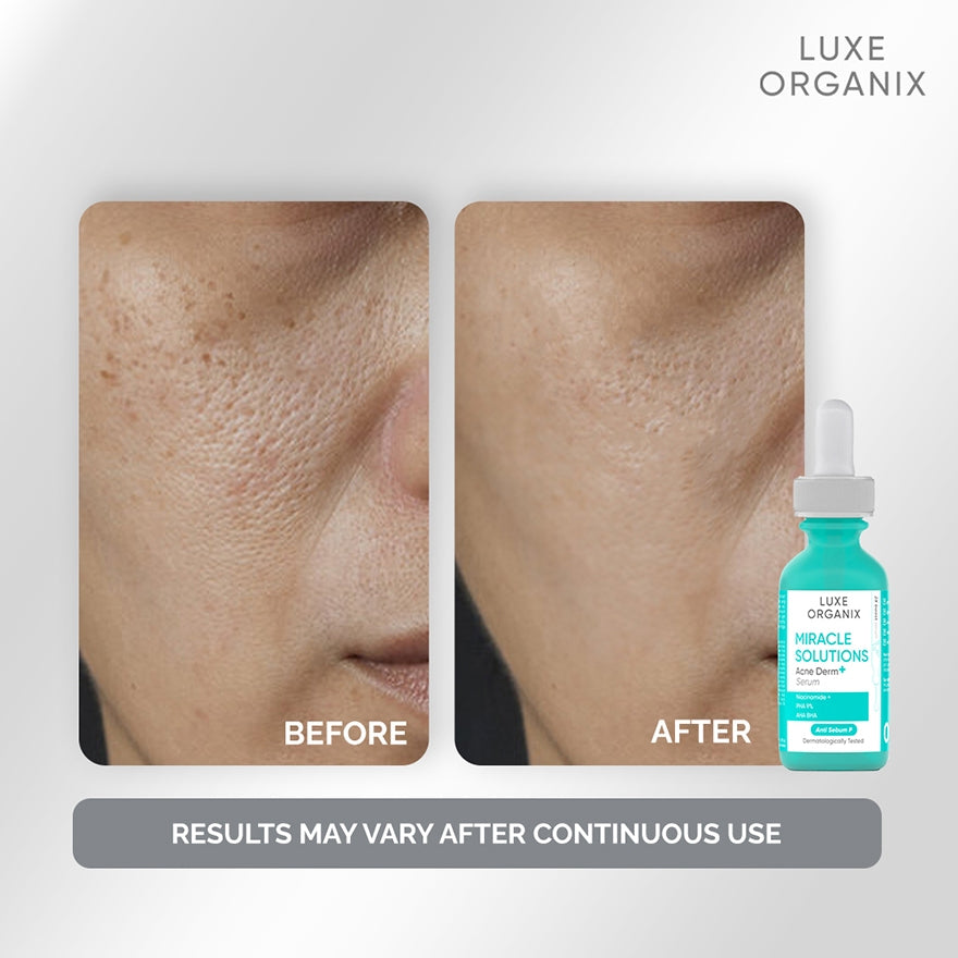 Luxe Organix Miracle Solutions Acne Derm+ Serum | Bini Beauty