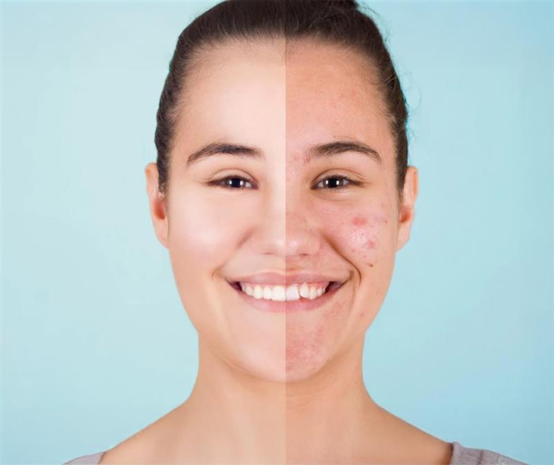 acne before & after