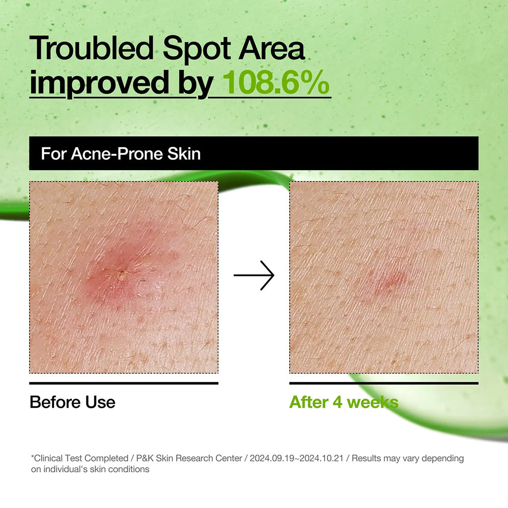 Anua Azelaic Acid 10 Hyaluron Redness Soothing Serum 30ml before and after use