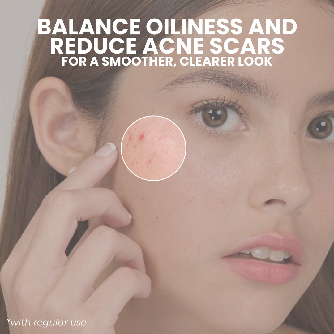 Luxe Organix Acne Balance & Rescue Bundle