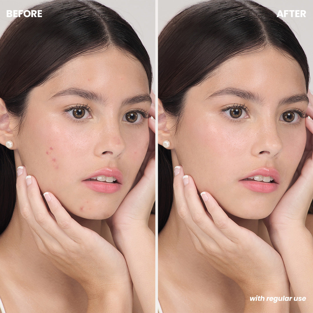 Luxe Organix Miracle Solutions Acne Derm+ Pimple Corrector 20g before and after