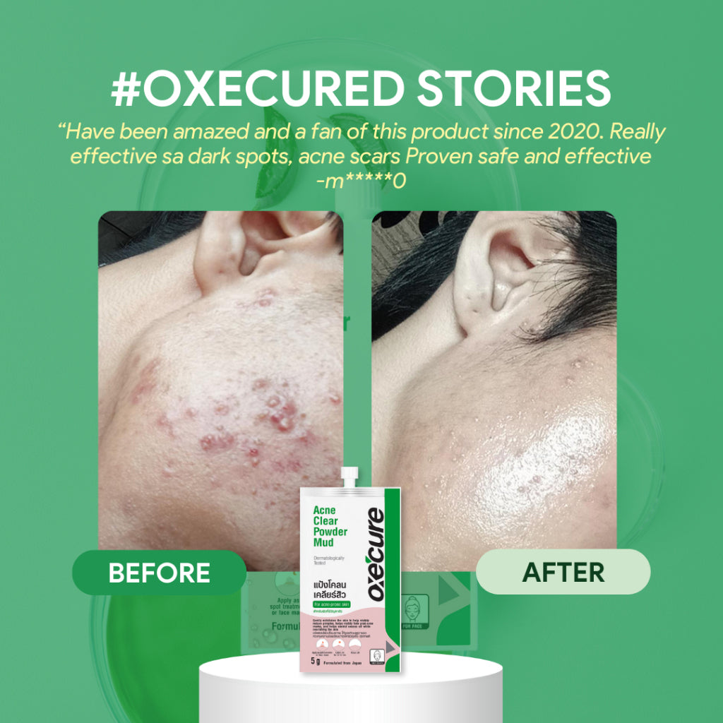 Oxecure Acne Clear Powder Mud | Skincare NZ AU - before and after