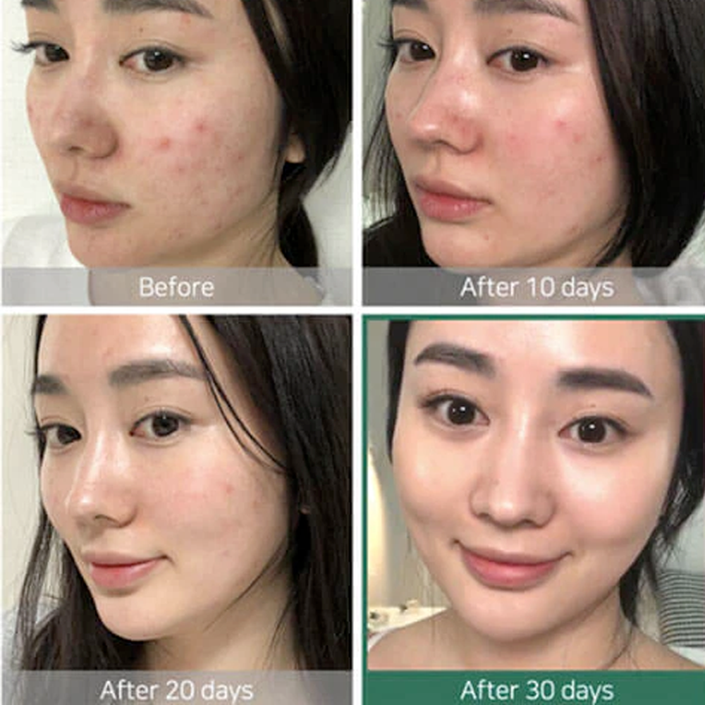 Some By Mi 30 Days Miracle Toner | Korean Skincare NZ AU - Bini Beauty - results